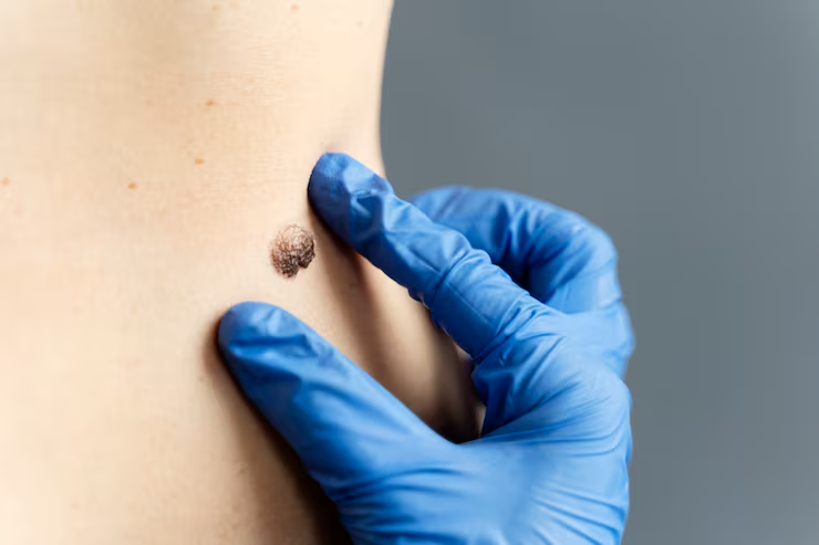 Signs It May Be Time to Search for Mole Removal Near Me